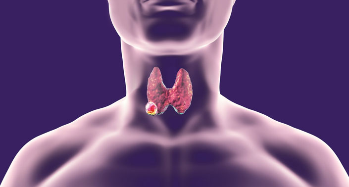 Mengenal kanker tiroid